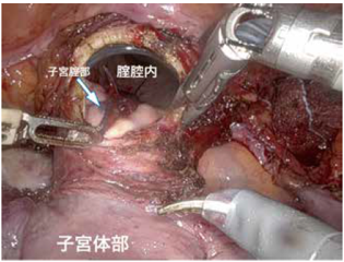 ロボット支援手術による子宮全摘術イメージ１