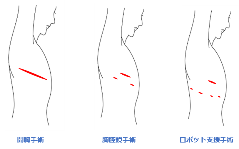 肺がんの手術創イメージ