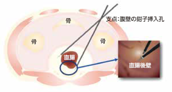 腹腔鏡手術のイメージ