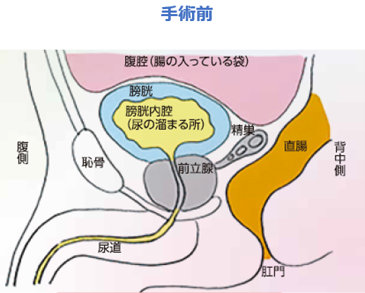 泌尿器科手術前イメージ