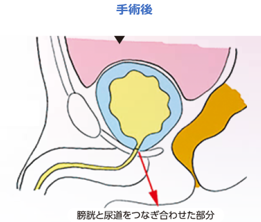 泌尿器科手術後イメージ